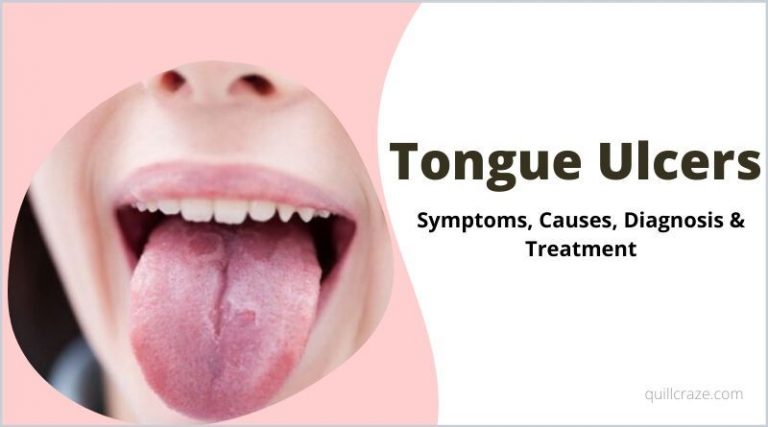 ppt-mouth-ulcers-causes-symptoms-and-herbal-treatment-powerpoint