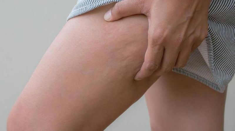 How to Get Rid of cellulite