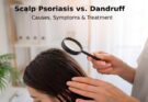 Scalp Psoriasis vs. Dandruff: How to Tell the Difference and Manage Them