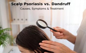 Dandruff vs. Scalp Psoriasis