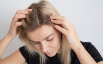 dandruff in winter