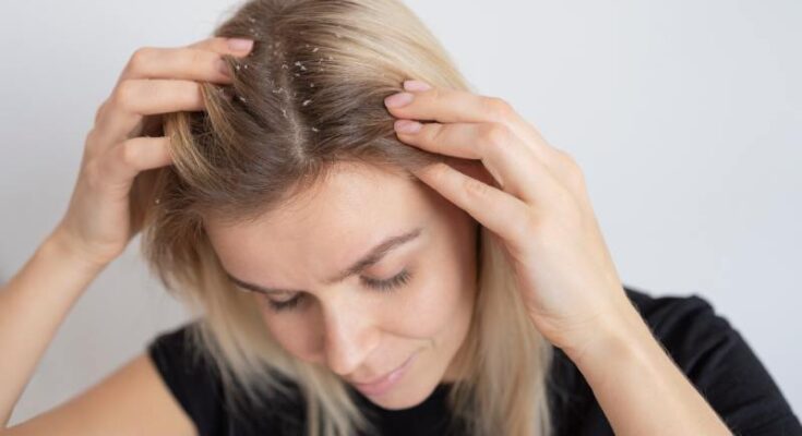 dandruff in winter